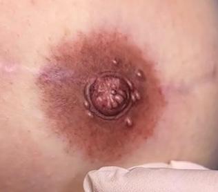 Areola